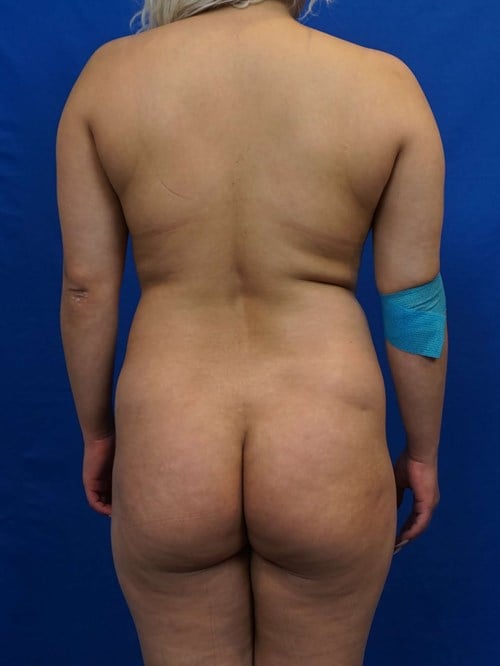 Liposuction before photo