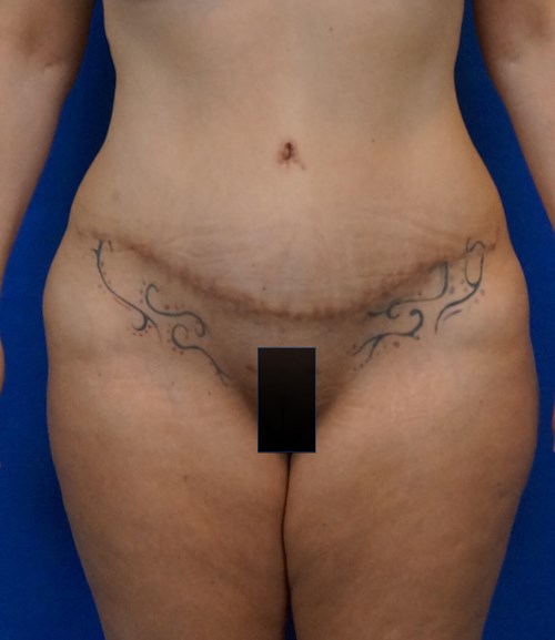 VIP Plastic Surgery tummy tuck after — Henderson, NV