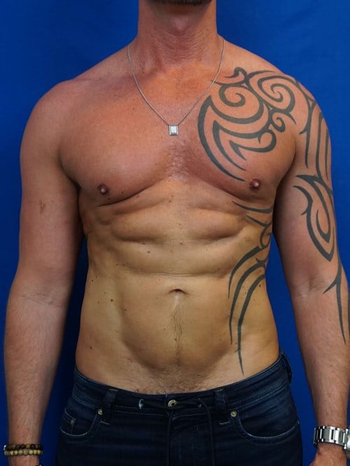 Liposuction result at VIP Plastic Surgery