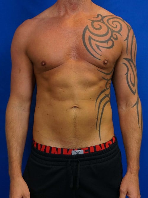 Liposuction before photo