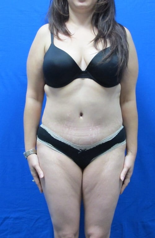 VIP Plastic Surgery tummy tuck after — Henderson, NV