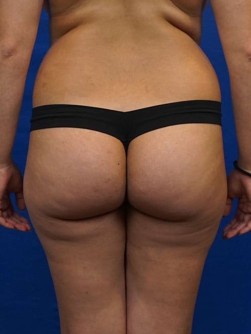 Liposuction before photo