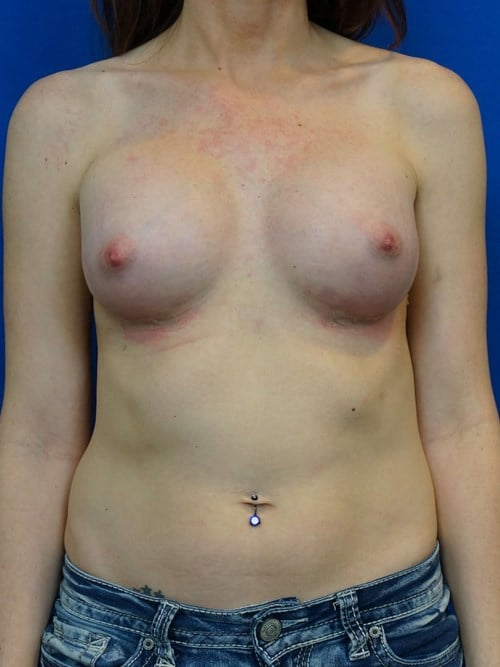 Breast Augmentation result at VIP Plastic Surgery