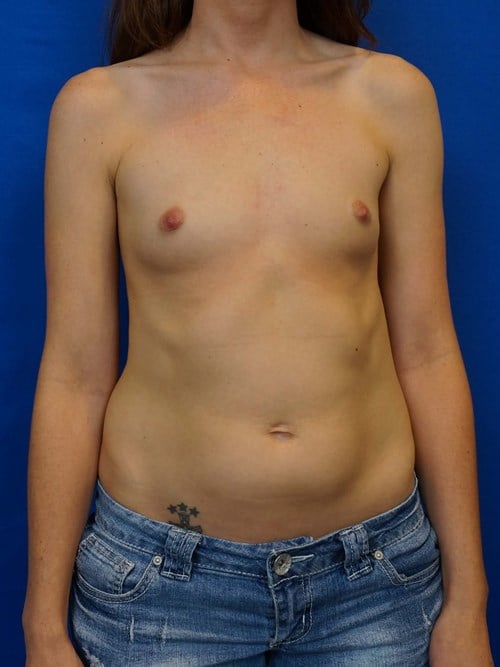 Breast Augmentation before photo
