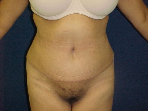 VIP Plastic Surgery tummy tuck after — Henderson, NV