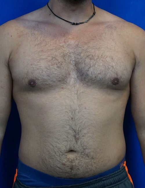 VIP Plastic Surgery liposuction after — Henderson, NV