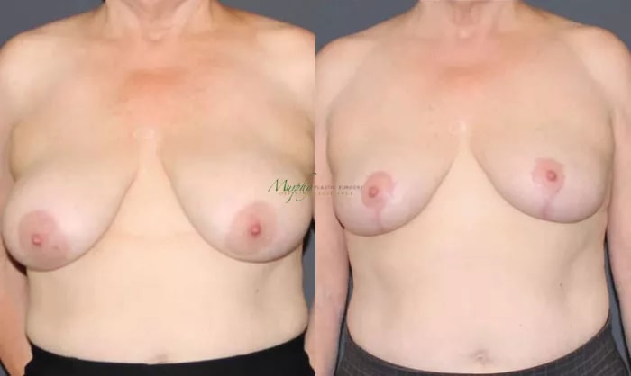 A result from Murphy Plastic Surgery Group