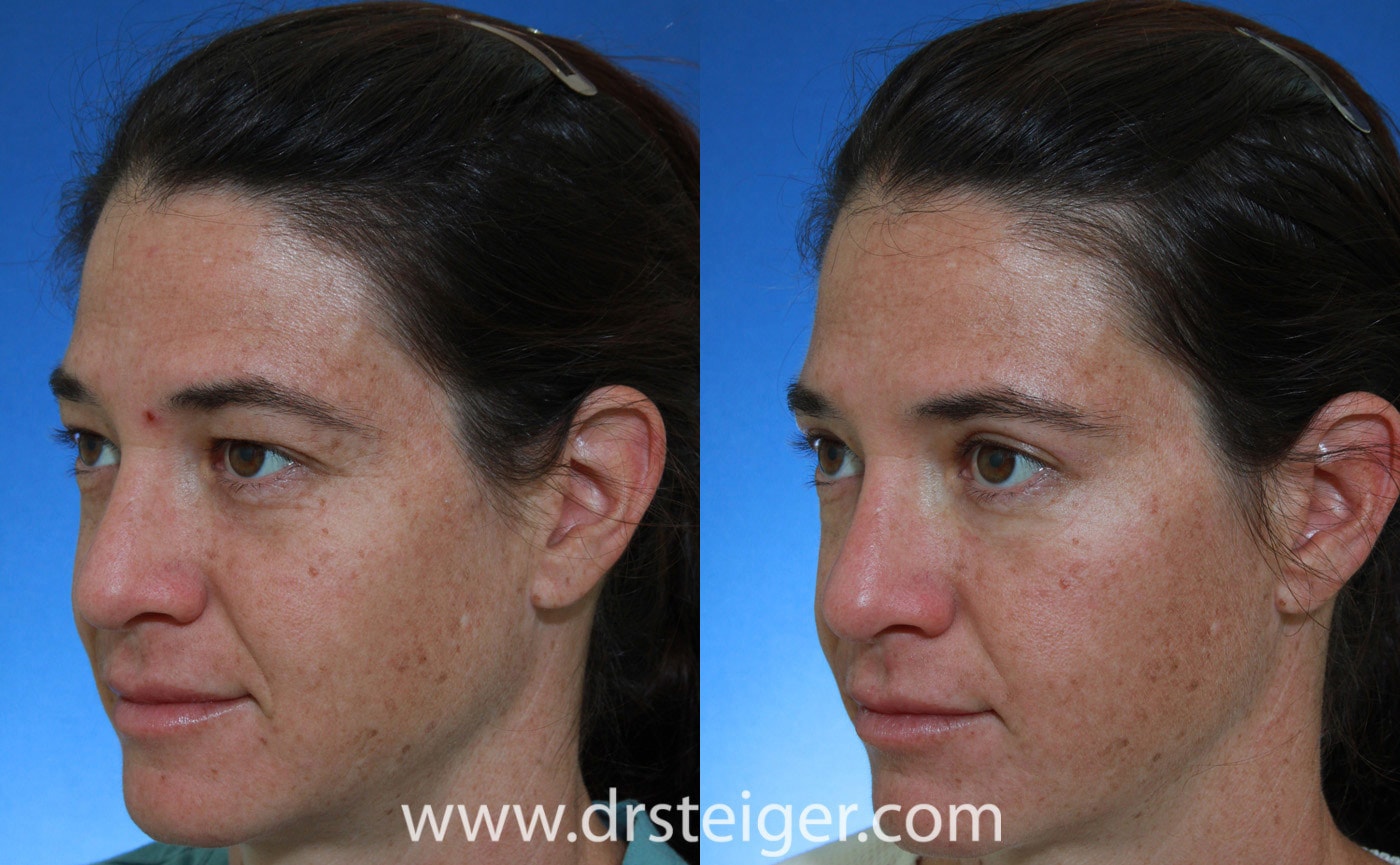 A result from Steiger Facial Plastic Surgery
