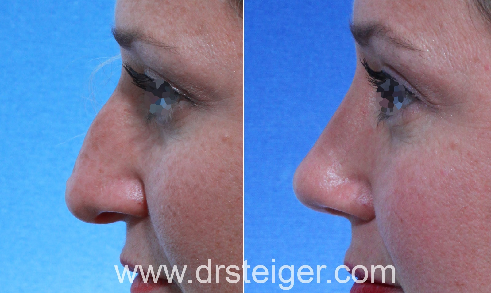 A result from Steiger Facial Plastic Surgery