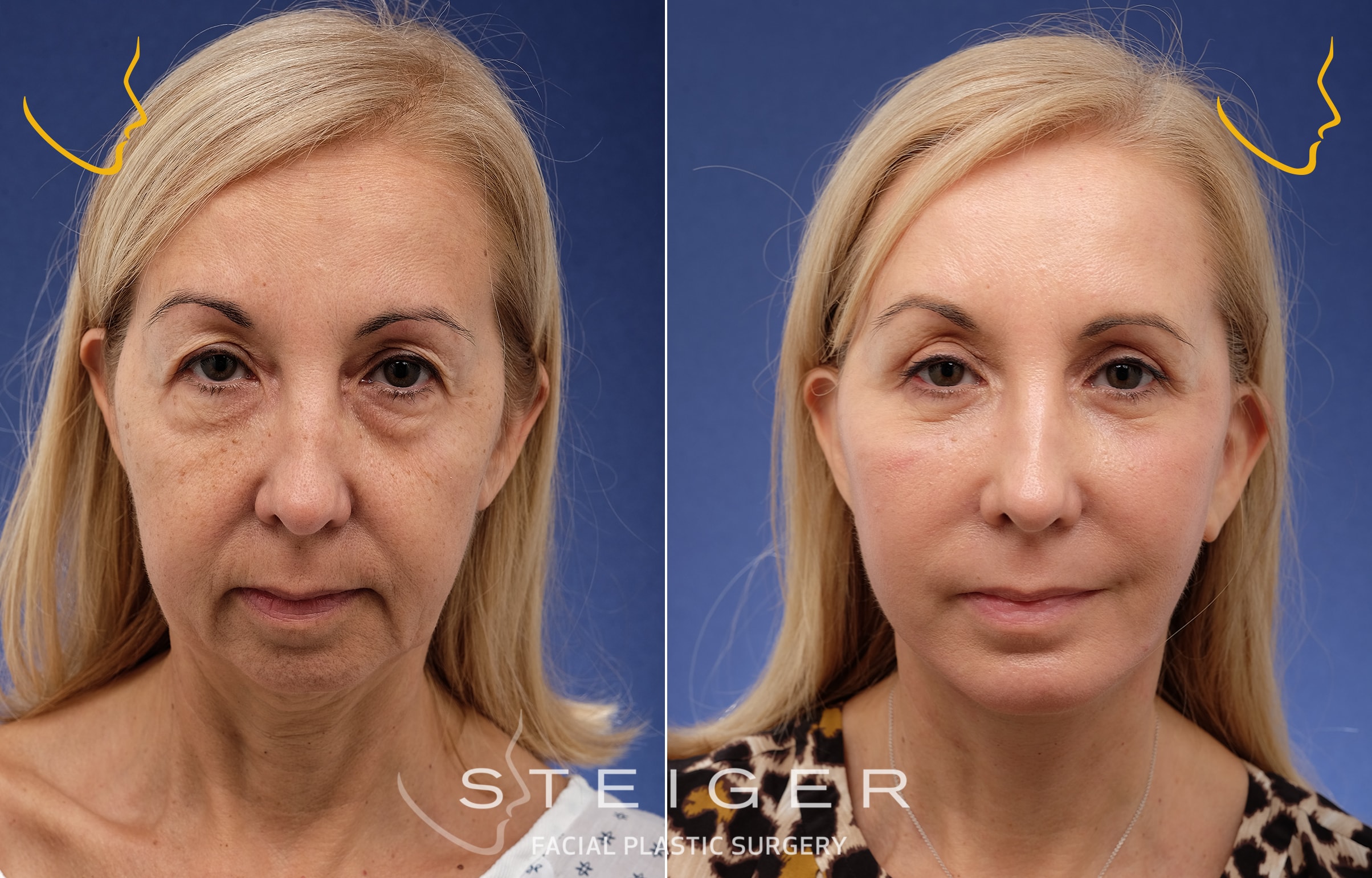 A result from Steiger Facial Plastic Surgery