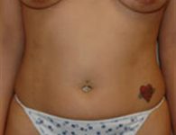 Liposuction result at SurgiSpa