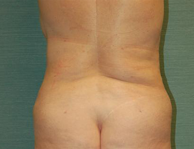 Liposuction result at SurgiSpa