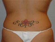 Liposuction result at SurgiSpa