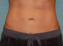 Liposuction result at SurgiSpa