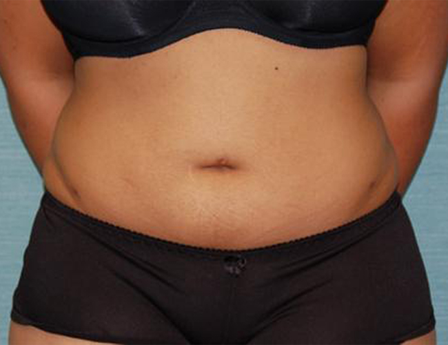 Liposuction result at SurgiSpa