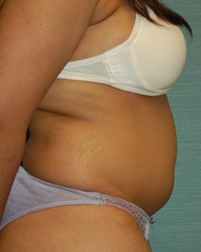 Liposuction result at SurgiSpa
