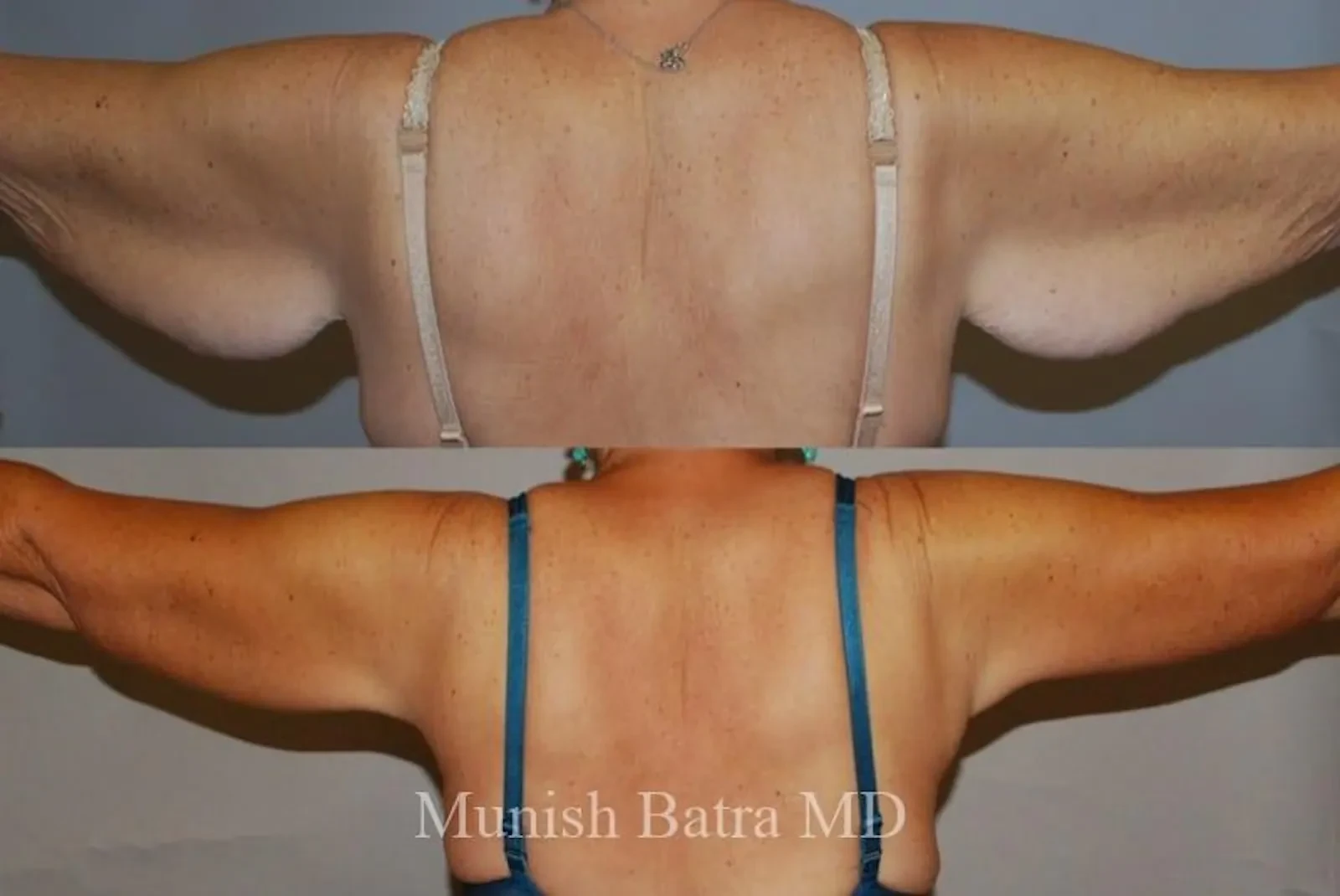 A result from Coastal Plastic Surgeons