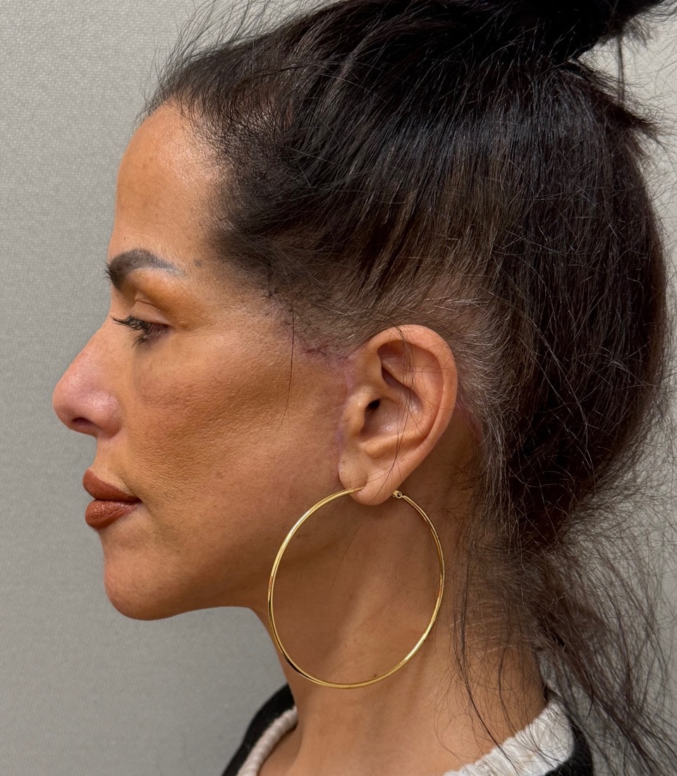 A result from Cosmetic Surgery Associates