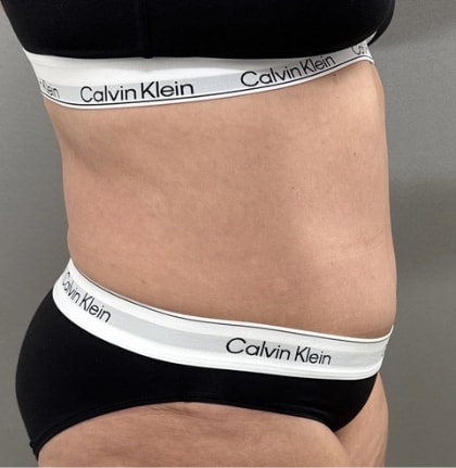 A result from Cosmetic Surgery Associates
