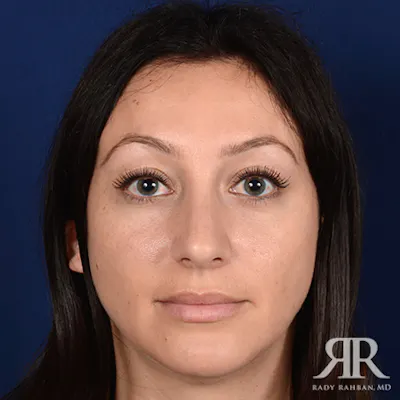 Procedure result at Dr. Rady Rahban