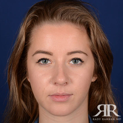 Procedure result at Dr. Rady Rahban