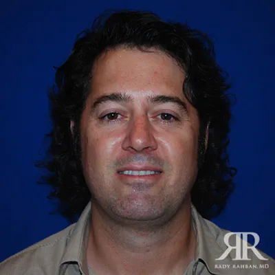 Procedure result at Dr. Rady Rahban