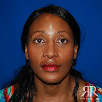 Procedure result at Dr. Rady Rahban