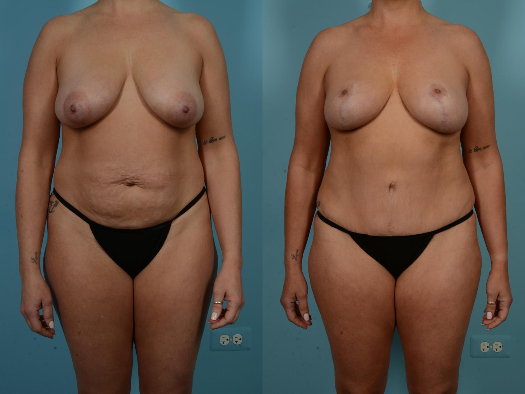 A result from TLKM Plastic Surgery (Sammy Sinno, MD)