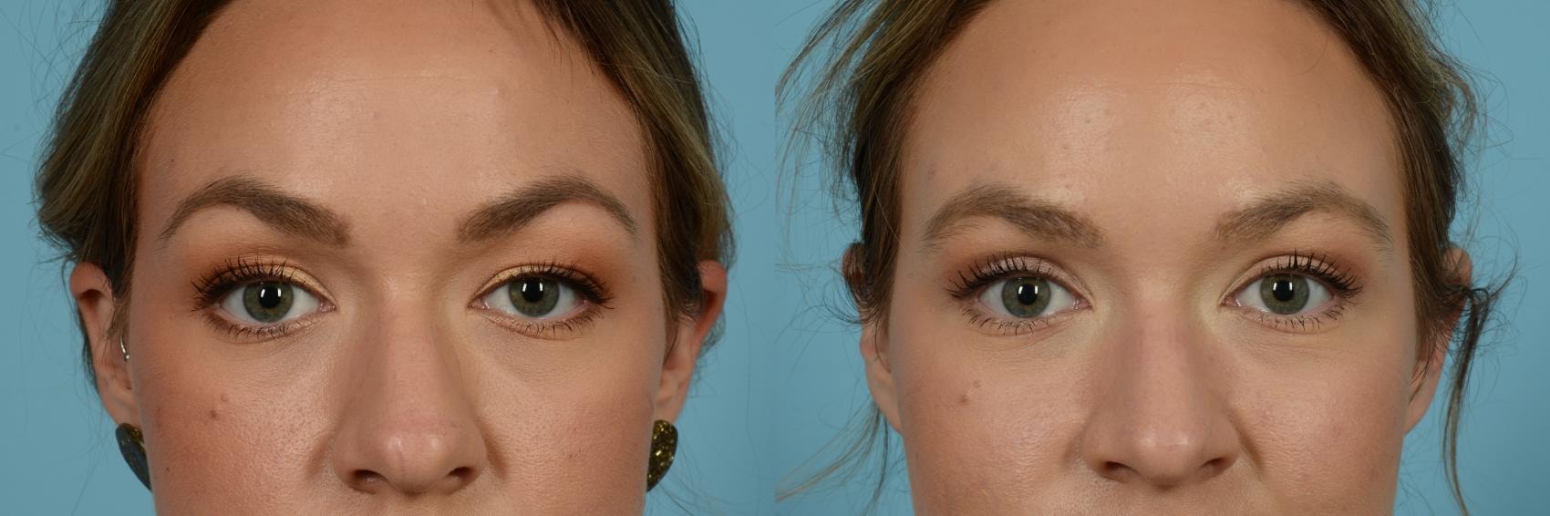 A result from TLKM Plastic Surgery (Sammy Sinno, MD)