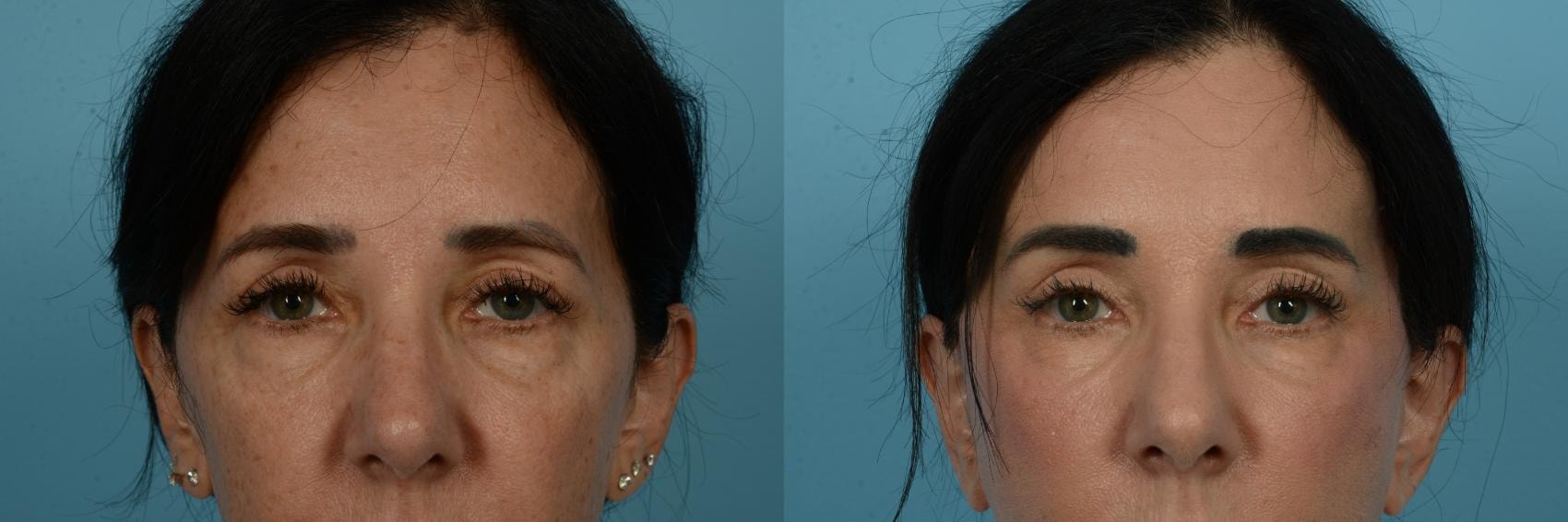 A result from TLKM Plastic Surgery (Sammy Sinno, MD)