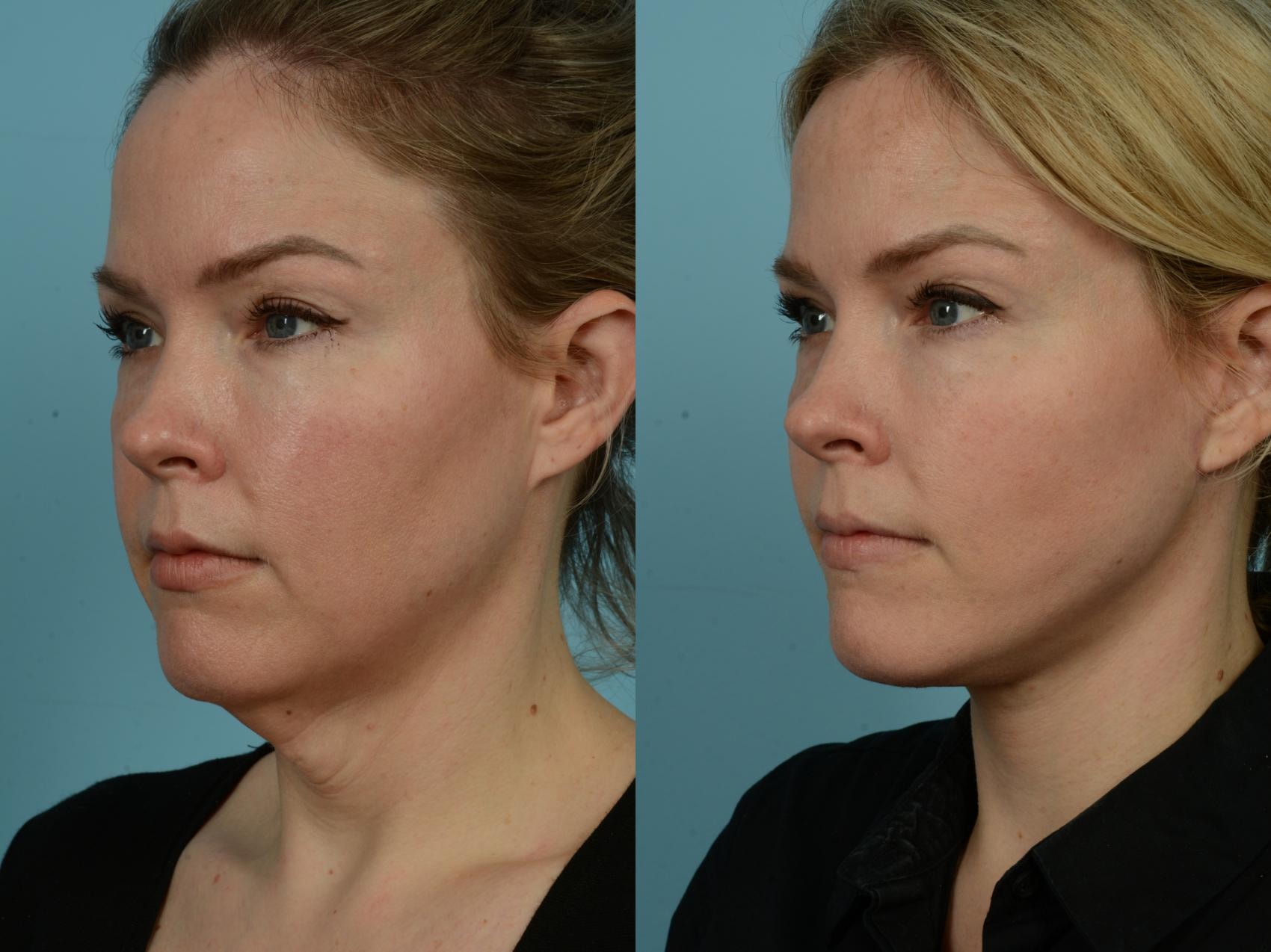 A result from TLKM Plastic Surgery (Sammy Sinno, MD)