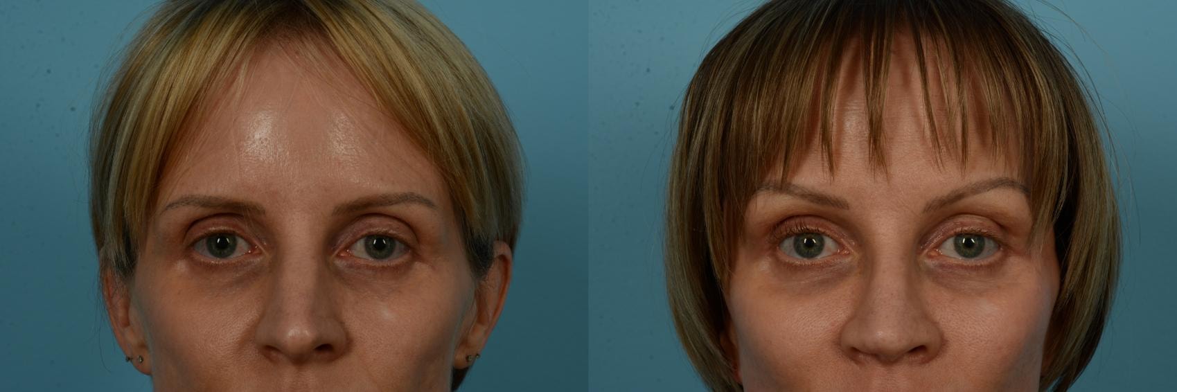 A result from TLKM Plastic Surgery (Sammy Sinno, MD)