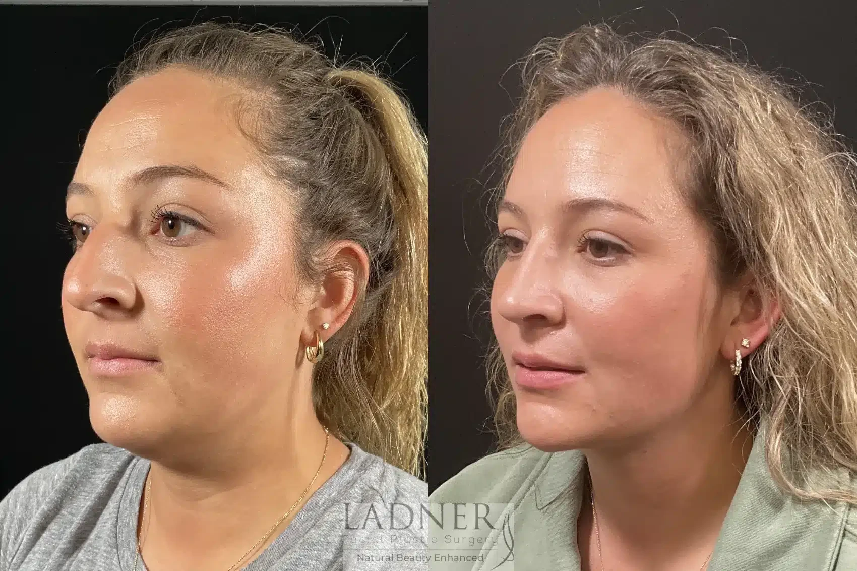 A result from Ladner Facial Plastic Surgery