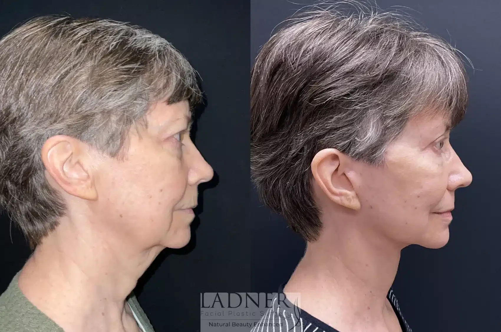 A result from Ladner Facial Plastic Surgery