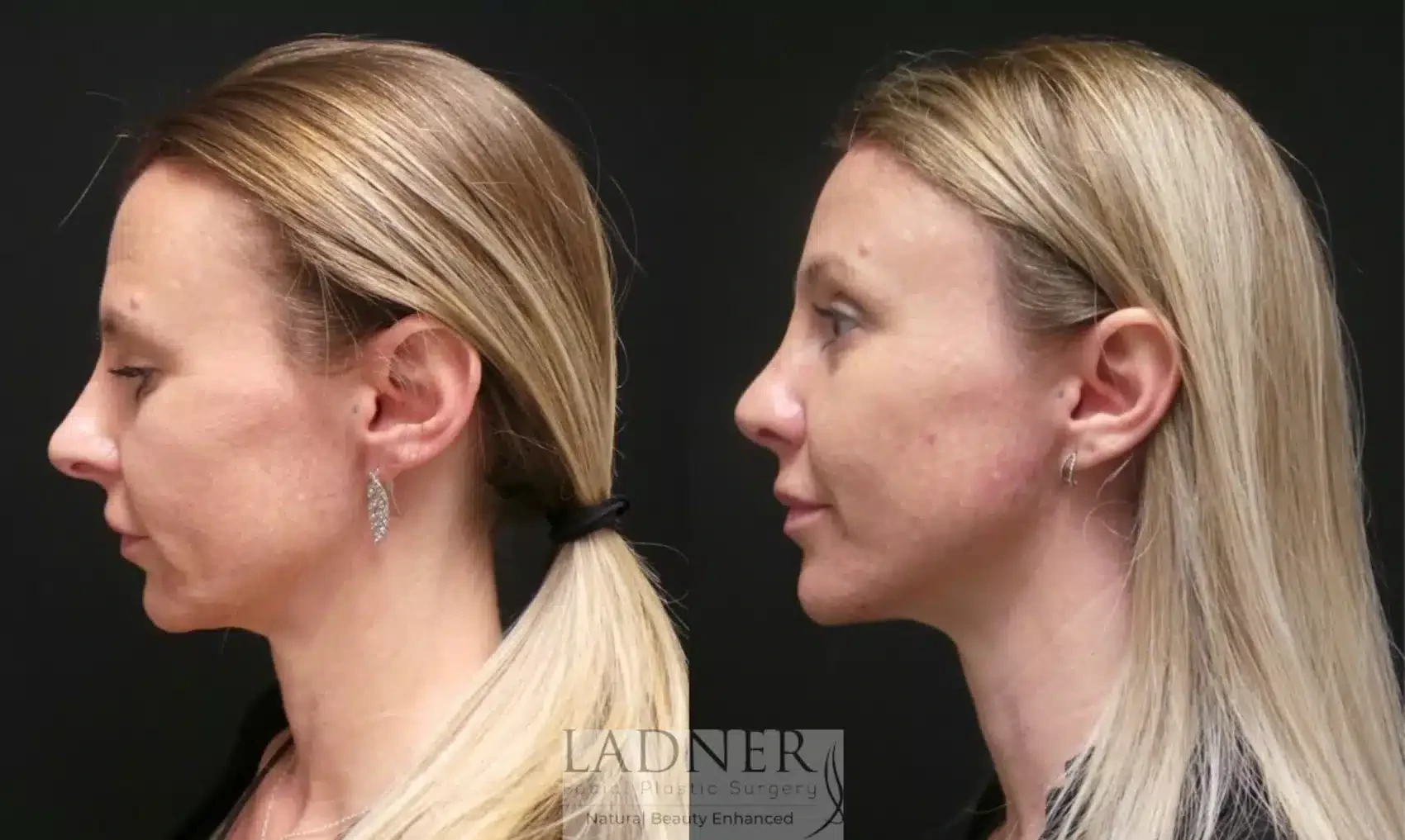 A result from Ladner Facial Plastic Surgery
