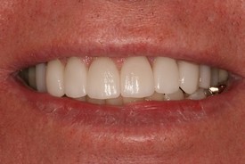 St. George Dental Care veneers after — St. George, UT