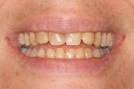 Hair Restoration result at St. George Dental Care