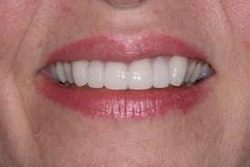 St. George Dental Care veneers after — St. George, UT