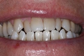 Veneers - Before & After