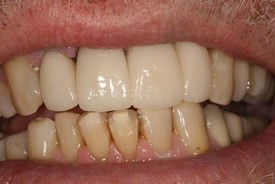St. George Dental Care veneers after — St. George, UT
