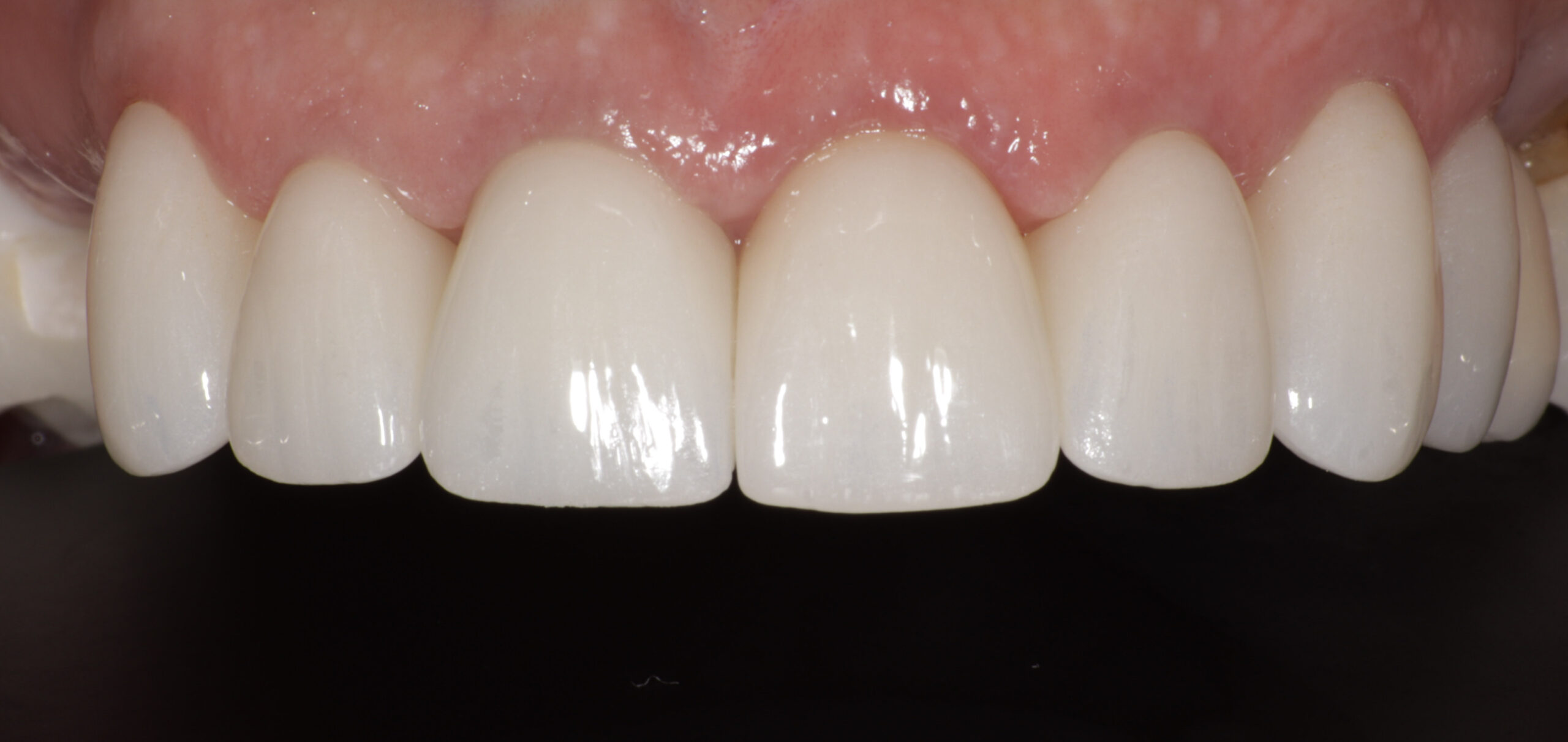 St. George Dental Care veneers after — St. George, UT