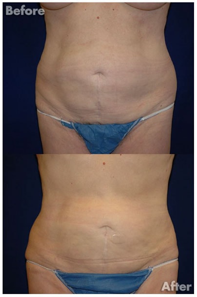 A result from Kirk A. Churukian MD FACS