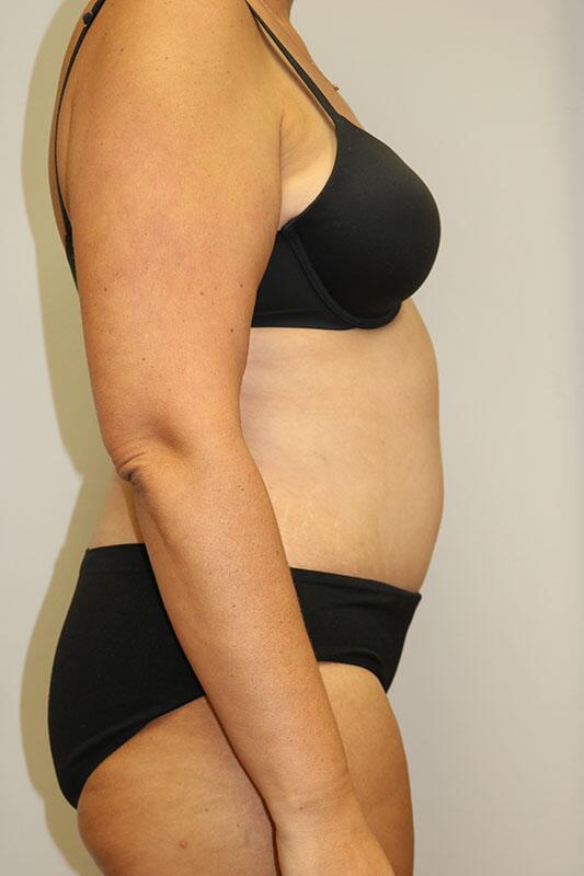 Tummy Tuck result at ARC Plastic Surgery