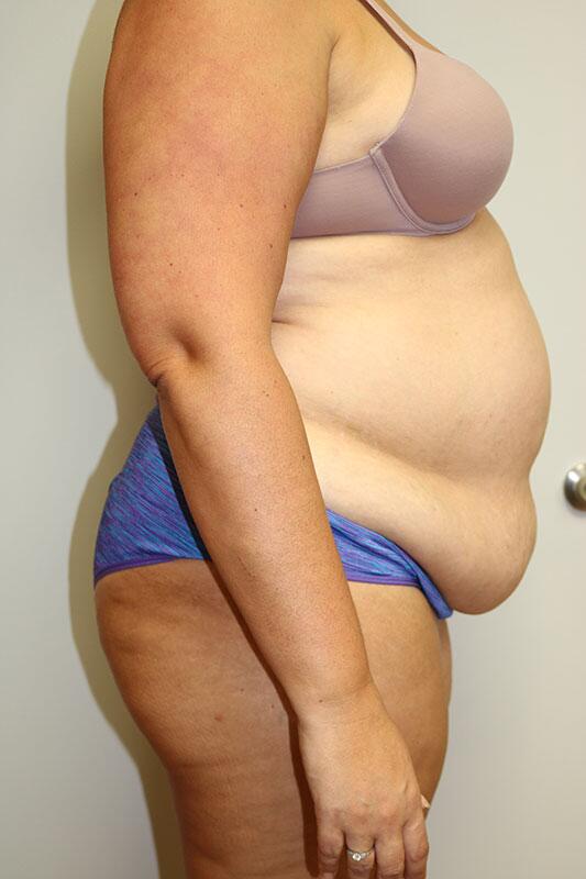 Tummy Tuck before photo