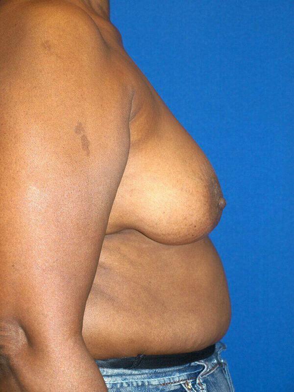 Breast Augmentation before photo