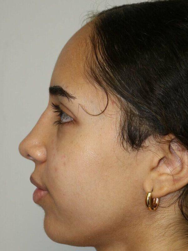 Rhinoplasty result at ARC Plastic Surgery
