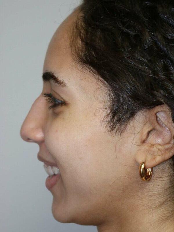 Rhinoplasty before photo