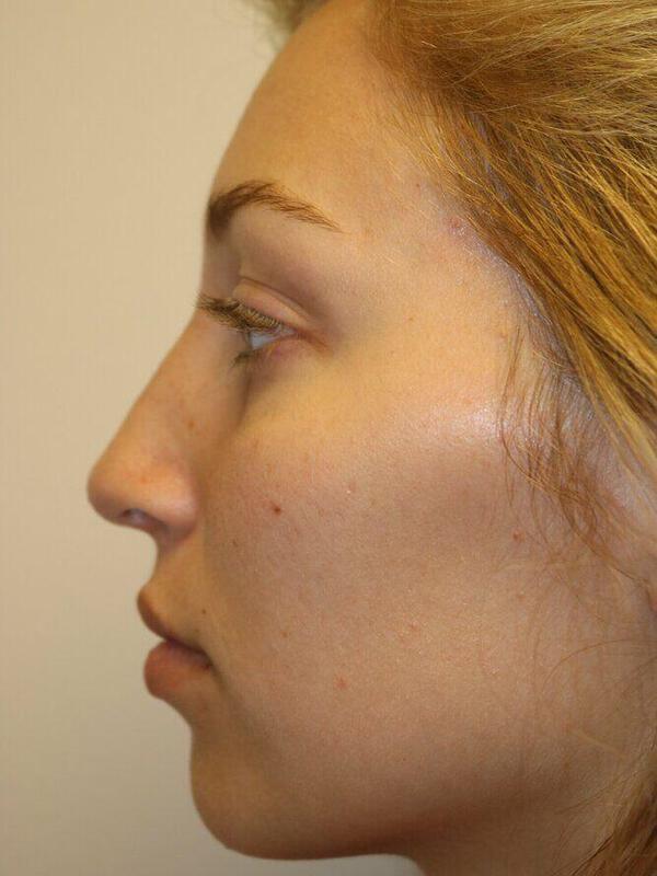Rhinoplasty result at ARC Plastic Surgery