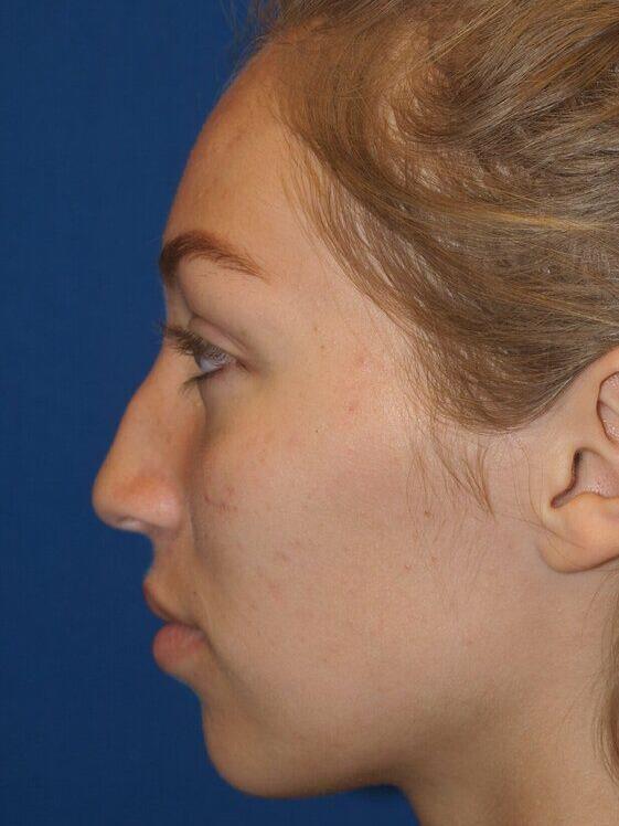 Rhinoplasty before photo