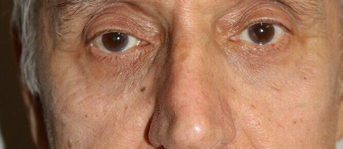 Blepharoplasty result at ARC Plastic Surgery
